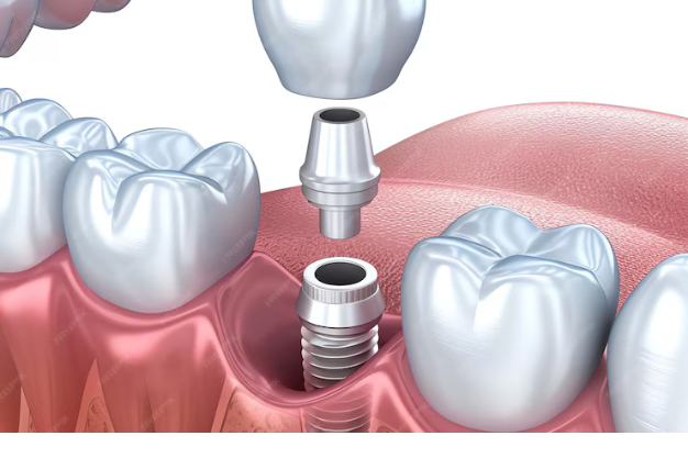 Tooth Replacement with Dental Implants