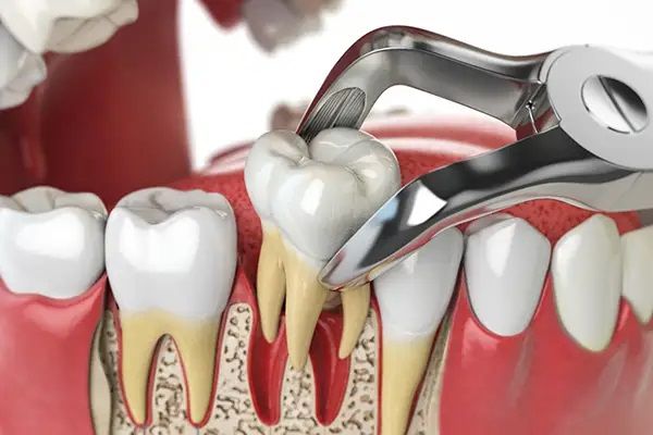 Dental Extraction